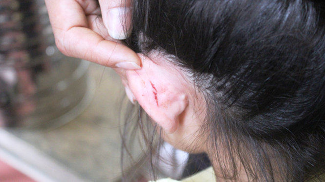 Bị cô giáo kéo tai, cháu N.T.H.T. bị một vết thương dài 3cm phía sau vành tai trái